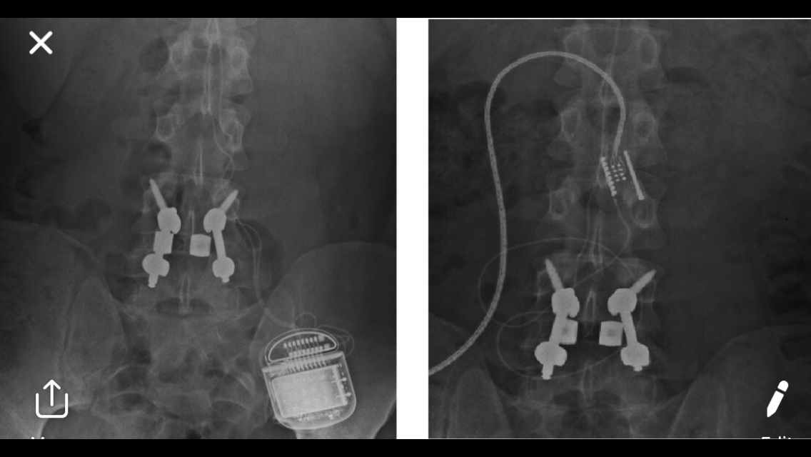 X-ray of Coun Watson\s spinal injury that he suffered during active service in Afghanistan in 2010. Picture uploaded by George Lythgoe. Credit: Councillor James Paul Watson. Free to use for all LDRS partners.